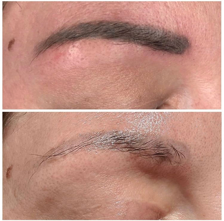 Permanent Make Up Entfernung München Remover Behandlung