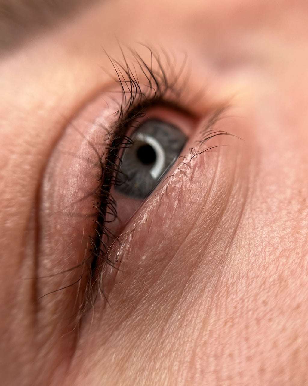 Wimpernkranzverdichtung München