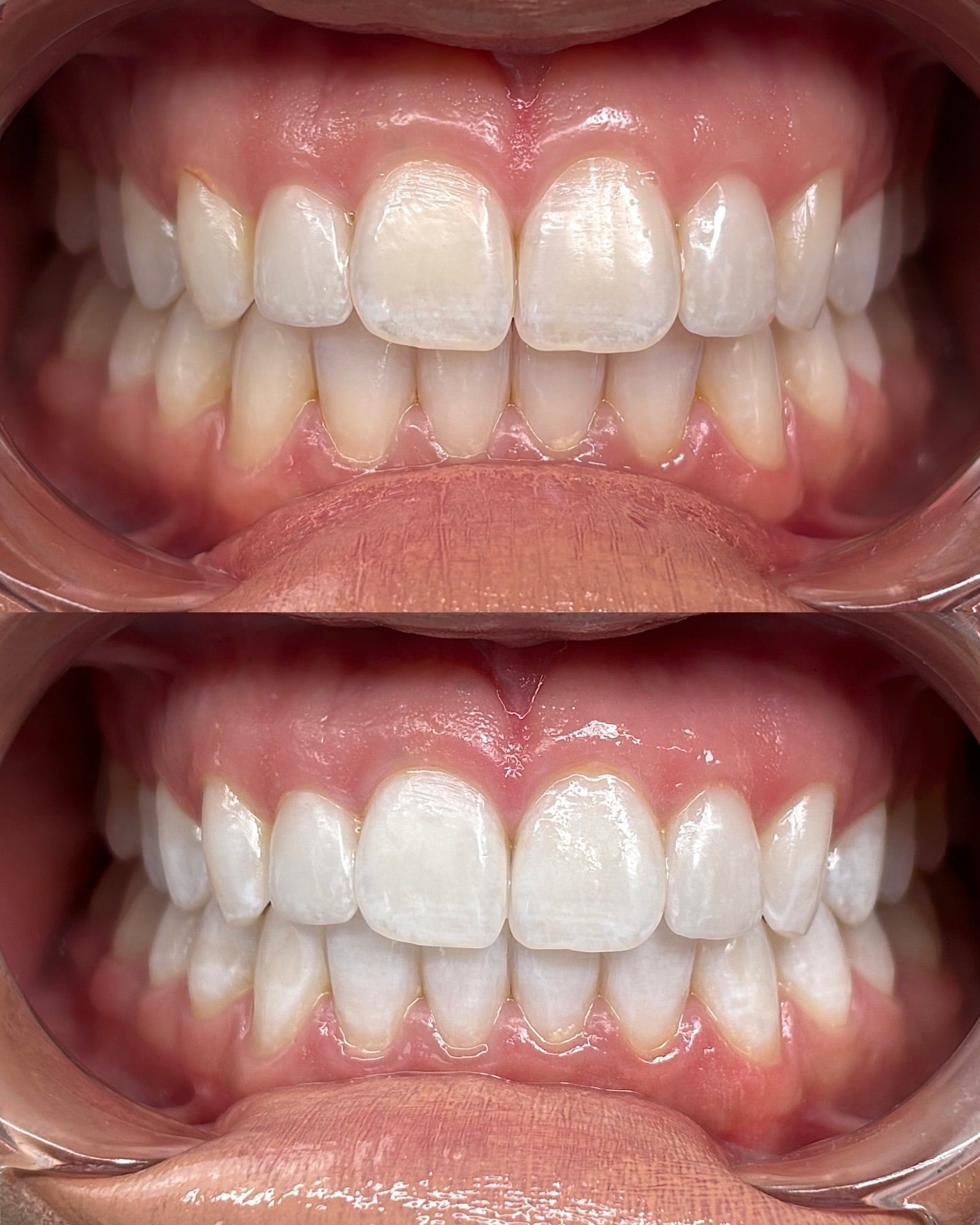 Zahnaufhellung - Zahnbleaching in München