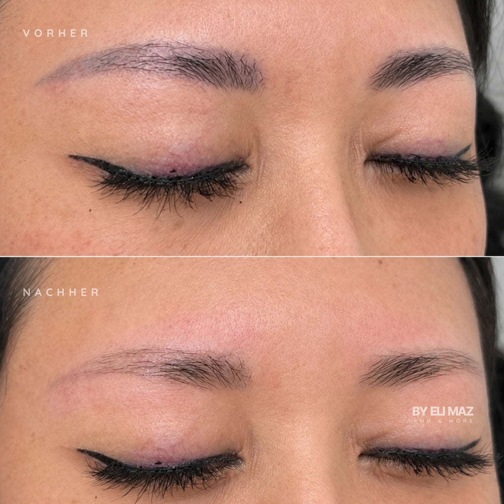 REMOVER (ohne Laser)