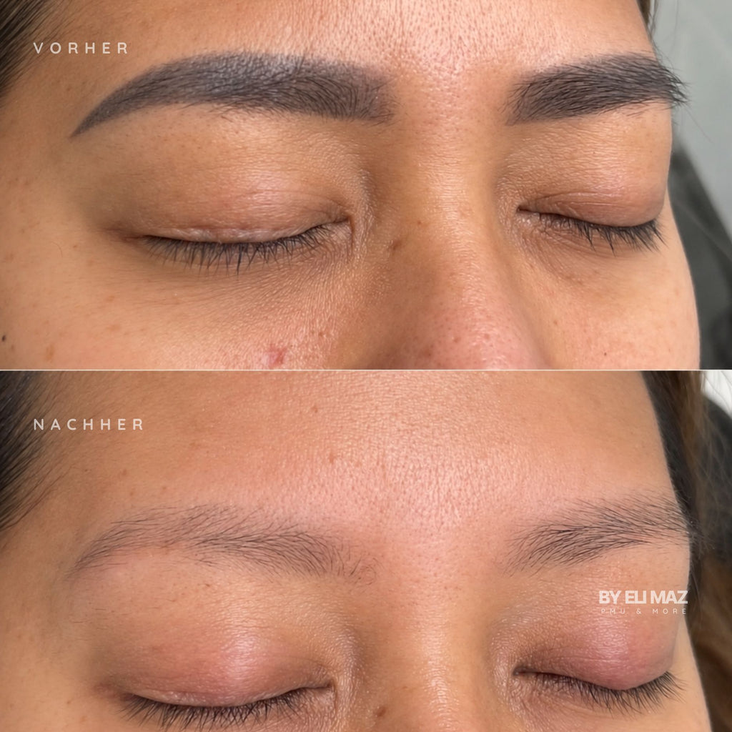 REMOVER (ohne Laser)