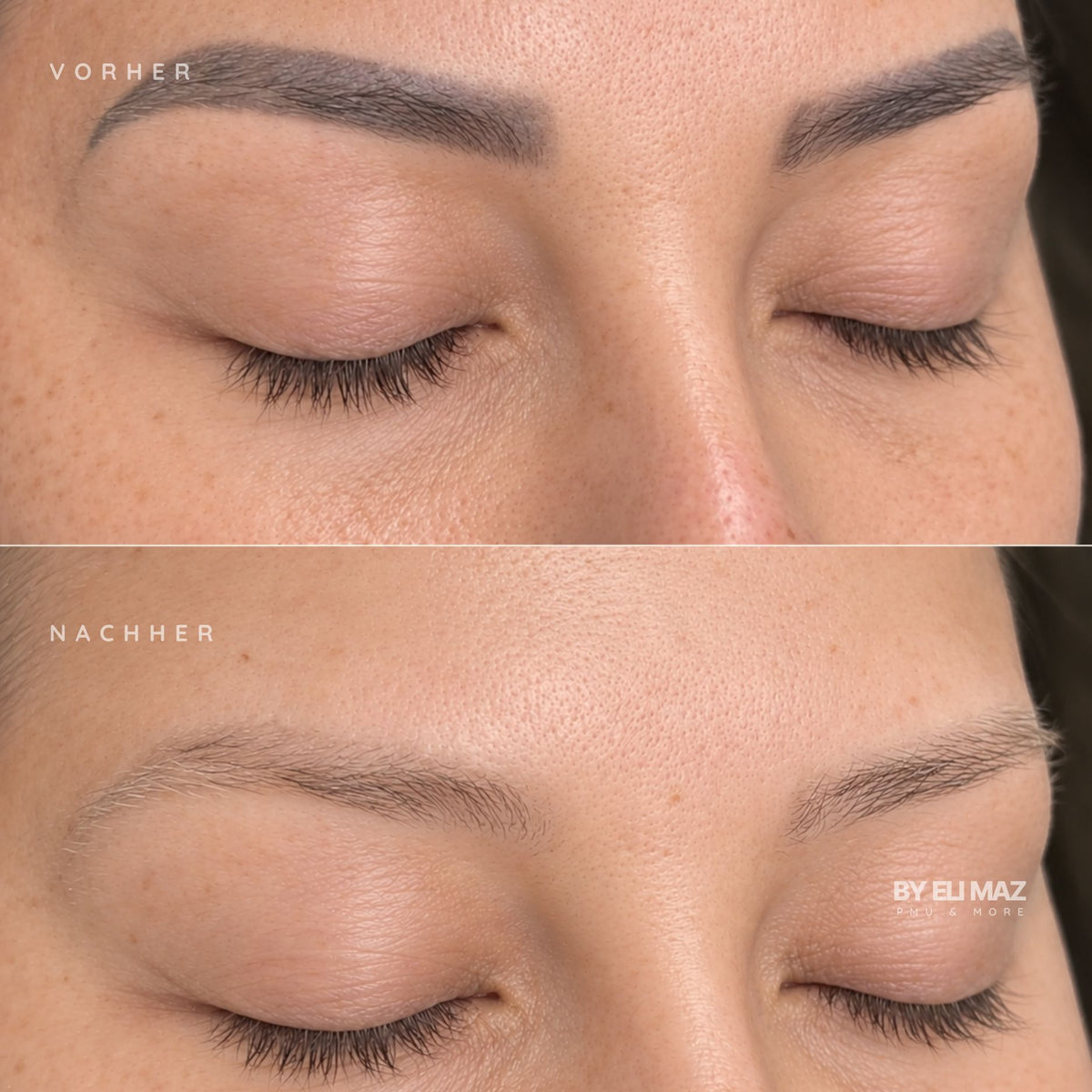 Entfernung Permanent Make-Up Augenbrauen München