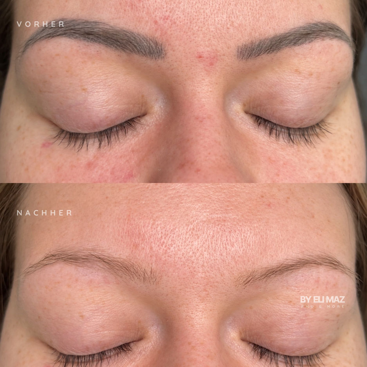 Entfernung Permanent Make-Up Augenbrauen München