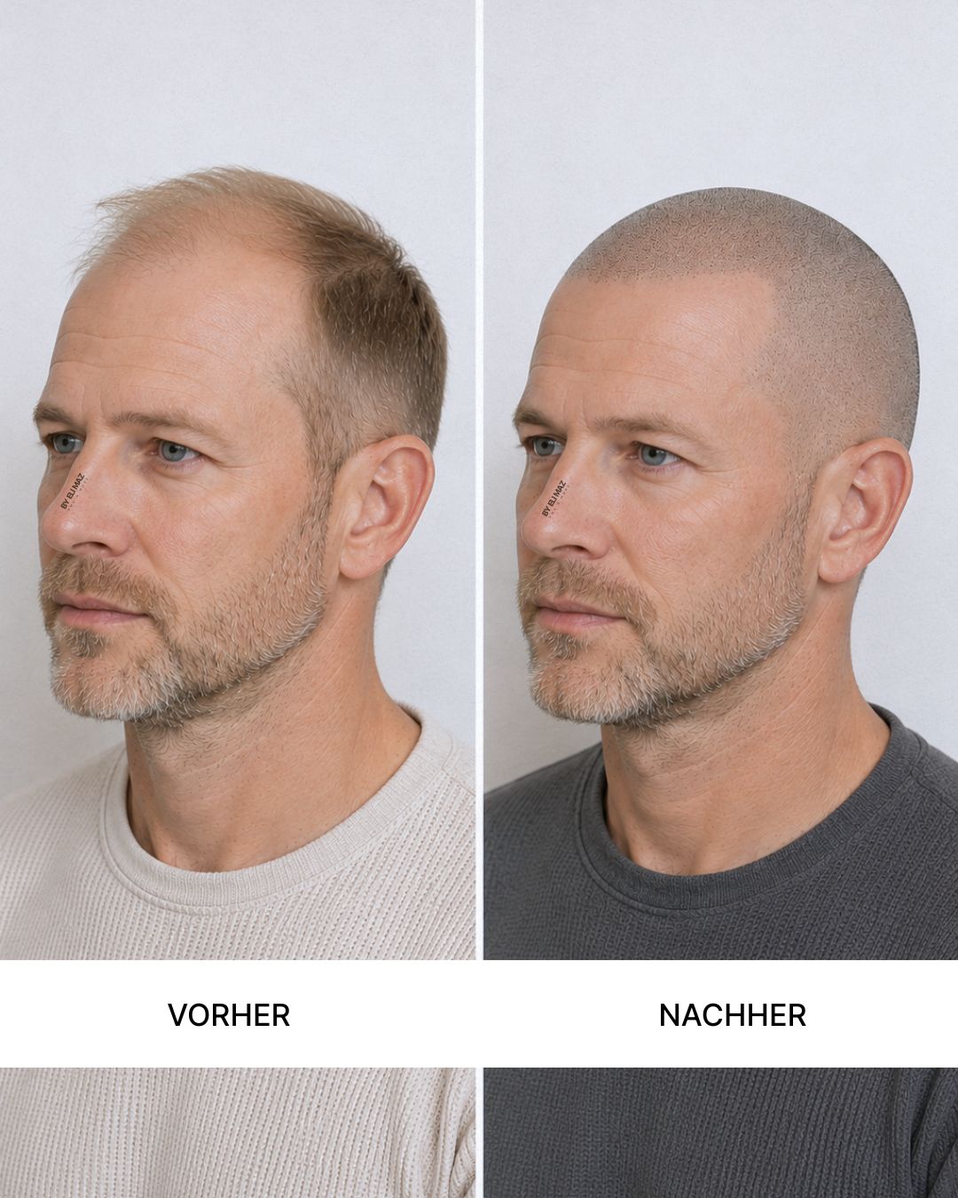 SMP Haarpigmentierung in München1