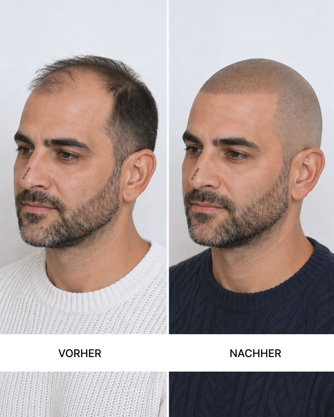 SMP Haarpigmentierung in München2