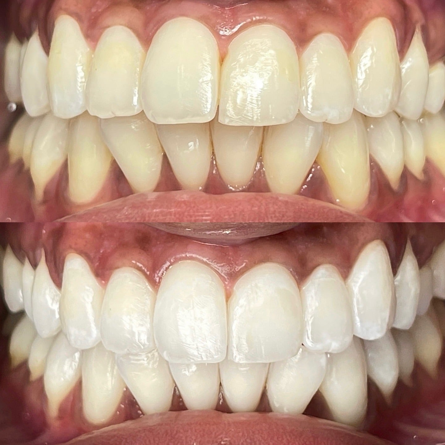 Zahnaufhellung Zahnbleaching München 2