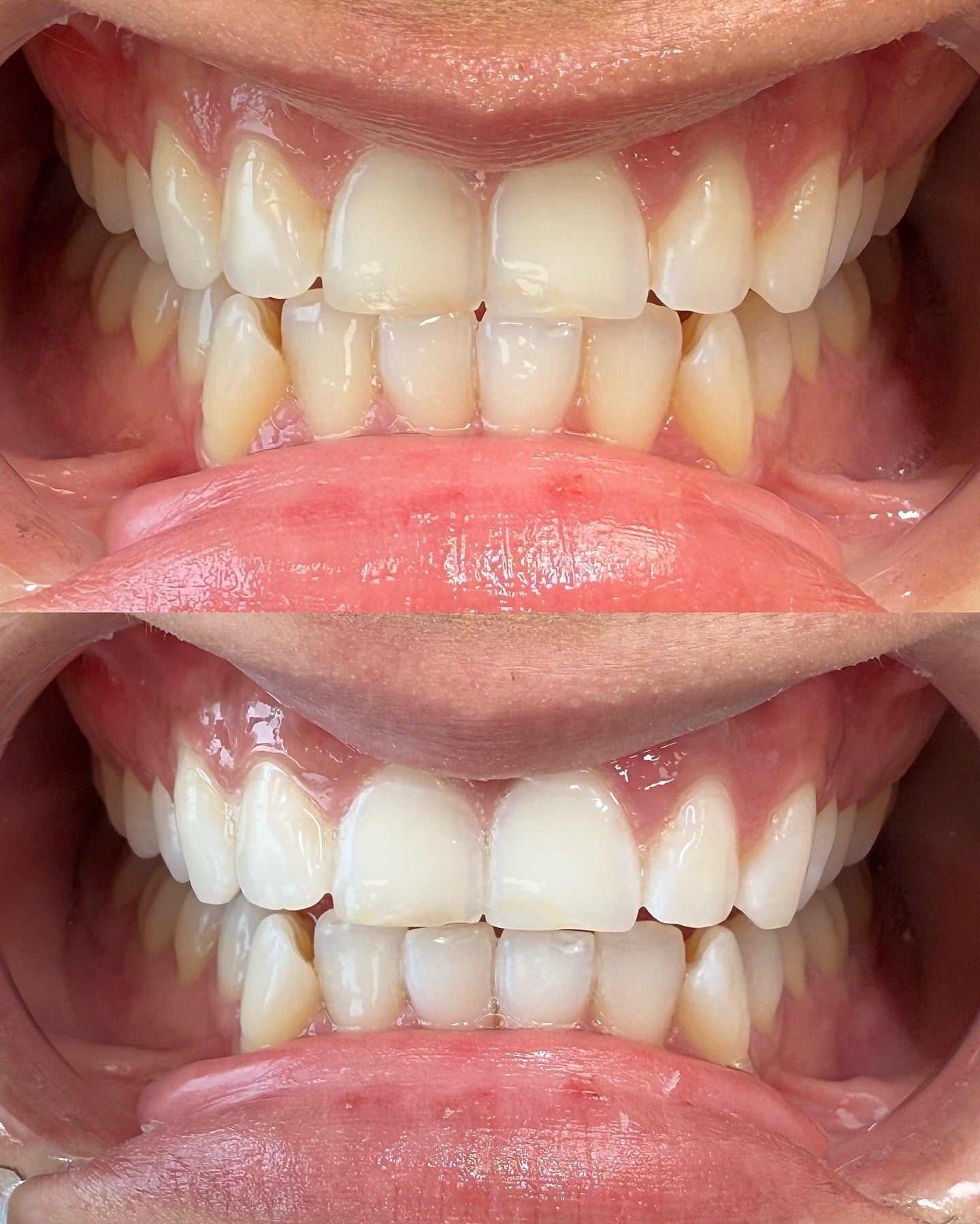 Zahnaufhellung Zahnbleaching München 3