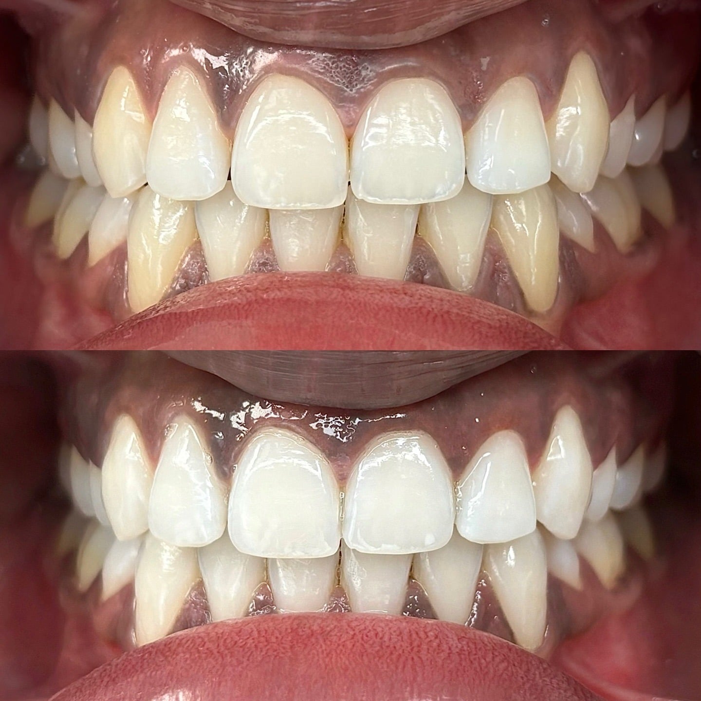 Zahnaufhellung Zahnbleaching München 4