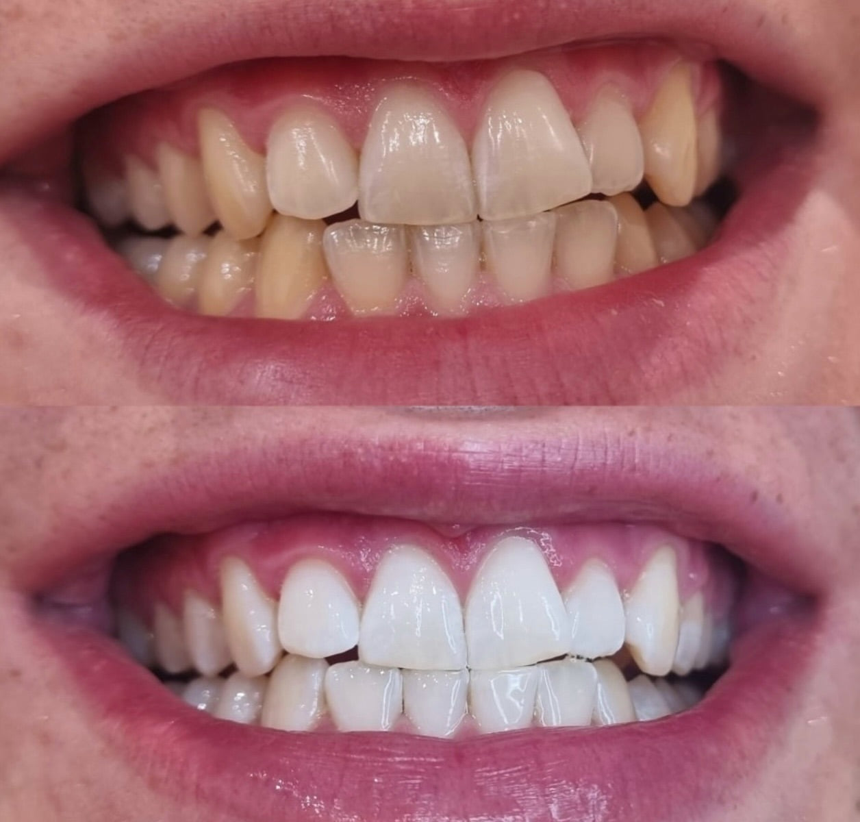 Zahnaufhellung Zahnbleaching München 5