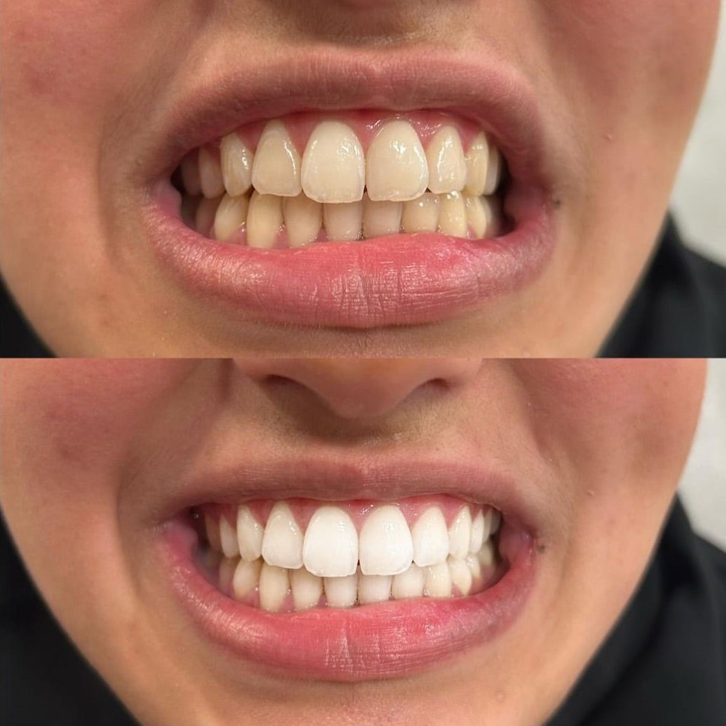 Zahnaufhellung Zahnbleaching München 7
