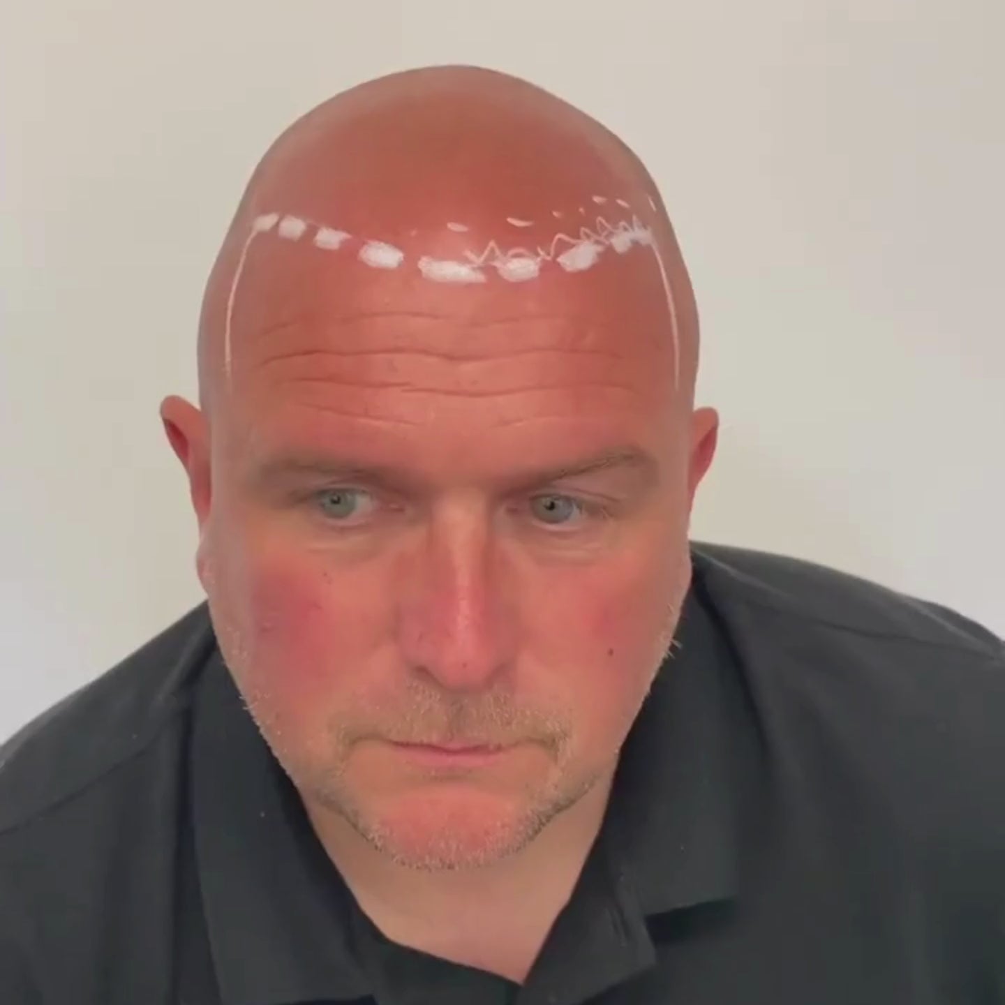 SMP Haarpigmentierung für Glatze München