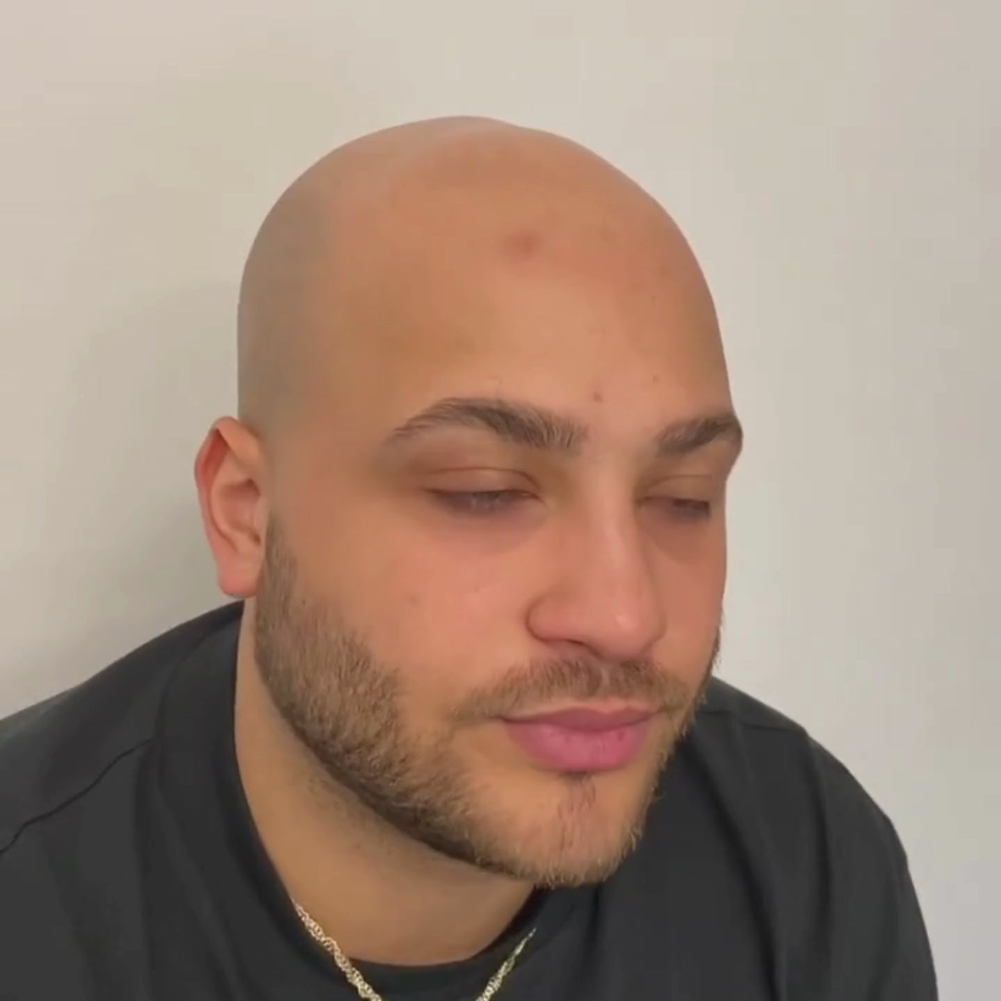 SMP Haarpigmentierung für Glatze München