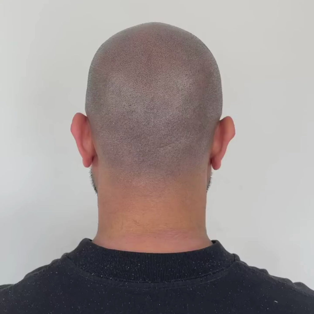 SMP Haarpigmentierung für Glatze München